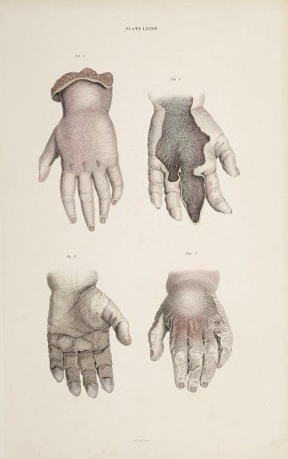[Epidermis of the hand] Anatomical William Home Lizars