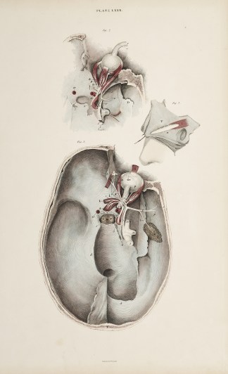 [ORGANS] Dissection of the eyes and skull, with op… Anatomical William Home Lizars