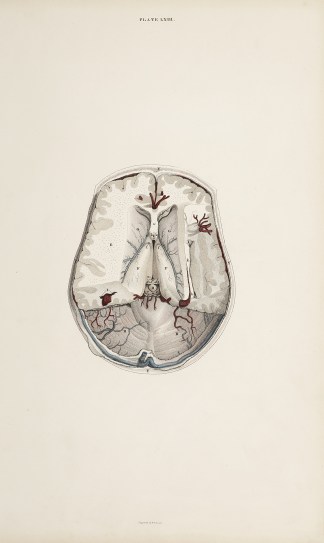 [BRAIN] Dissection of the brain Anatomical William Home Lizars